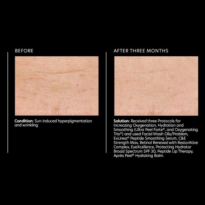 PCA Skin ExLinea Peptide Smoothing Serum 29.5 ml