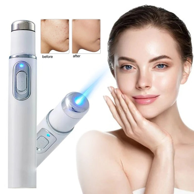 Magic Blue Light Acne Laser Removal