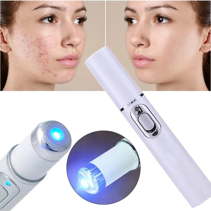 Magic Blue Light Acne Laser Removal