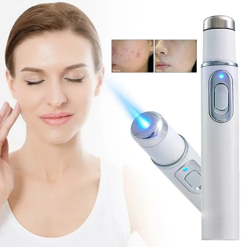 Magic Blue Light Acne Laser Removal