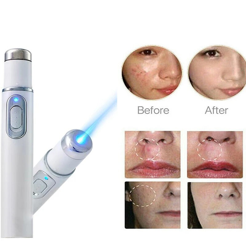 Magic Blue Light Acne Laser Removal