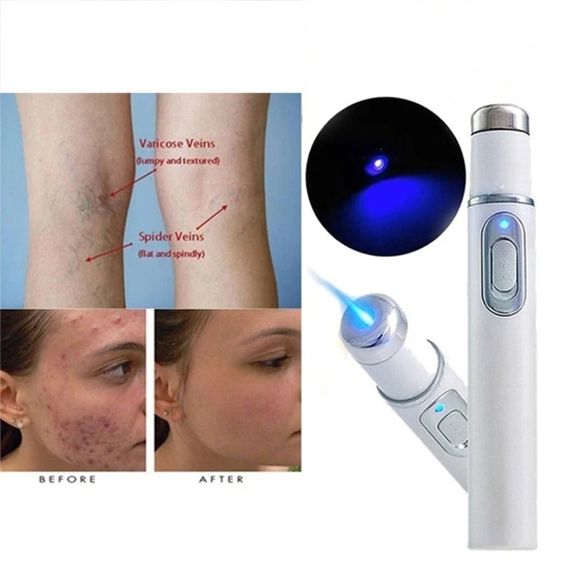 Magic Blue Light Acne Laser Removal