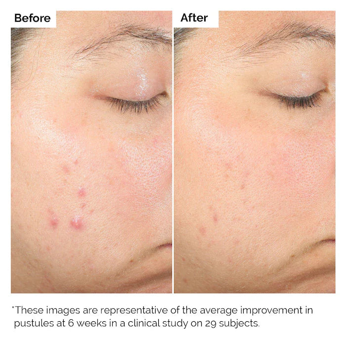 The Ordinary Salicylic Acid 2% Exfoliating Blemish Solution Serum 30ml