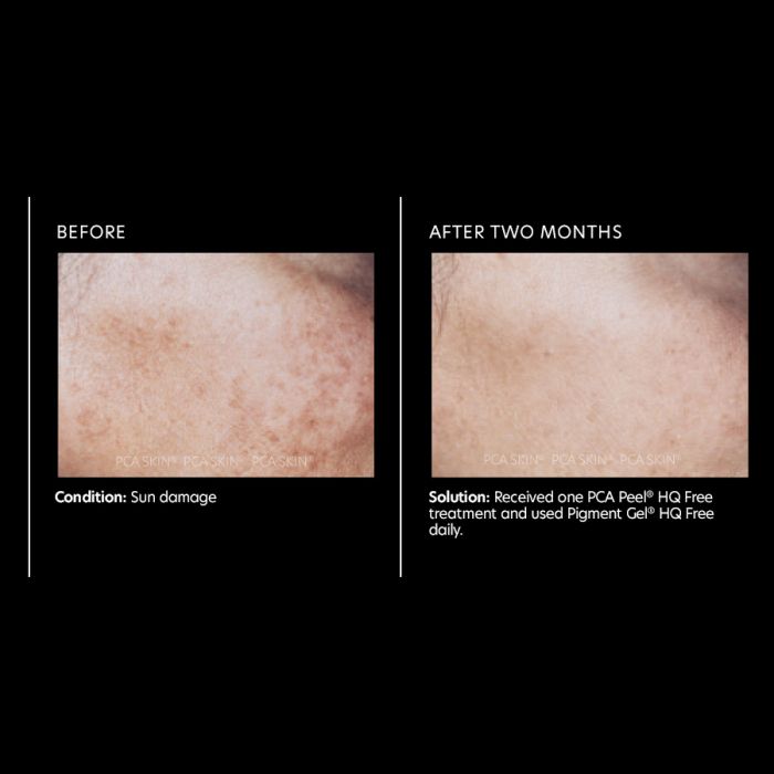 PCA Skin Pigment Gel HQ Free 29.5 ml