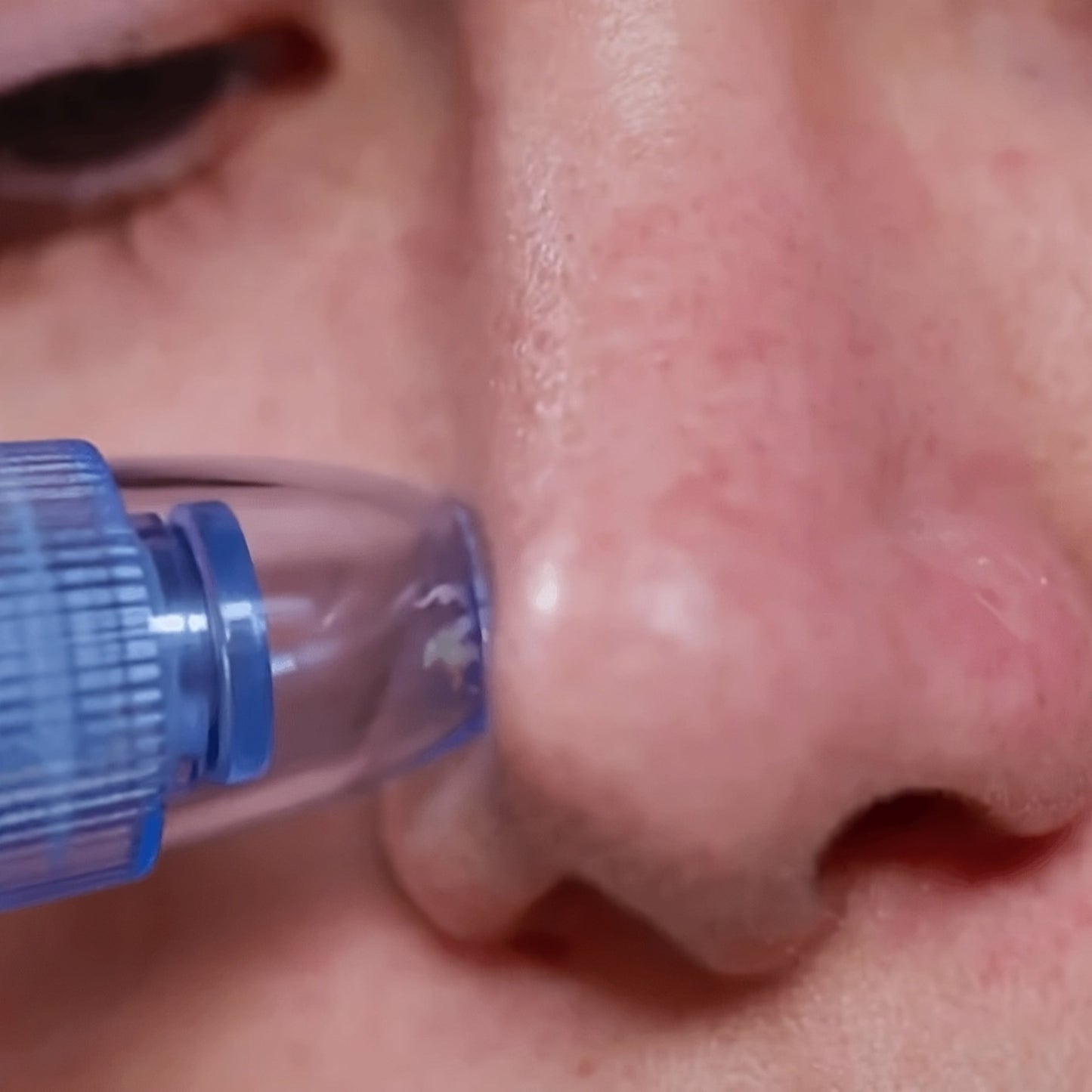 Blackhead Remover DermaSuction™ - Medaid International