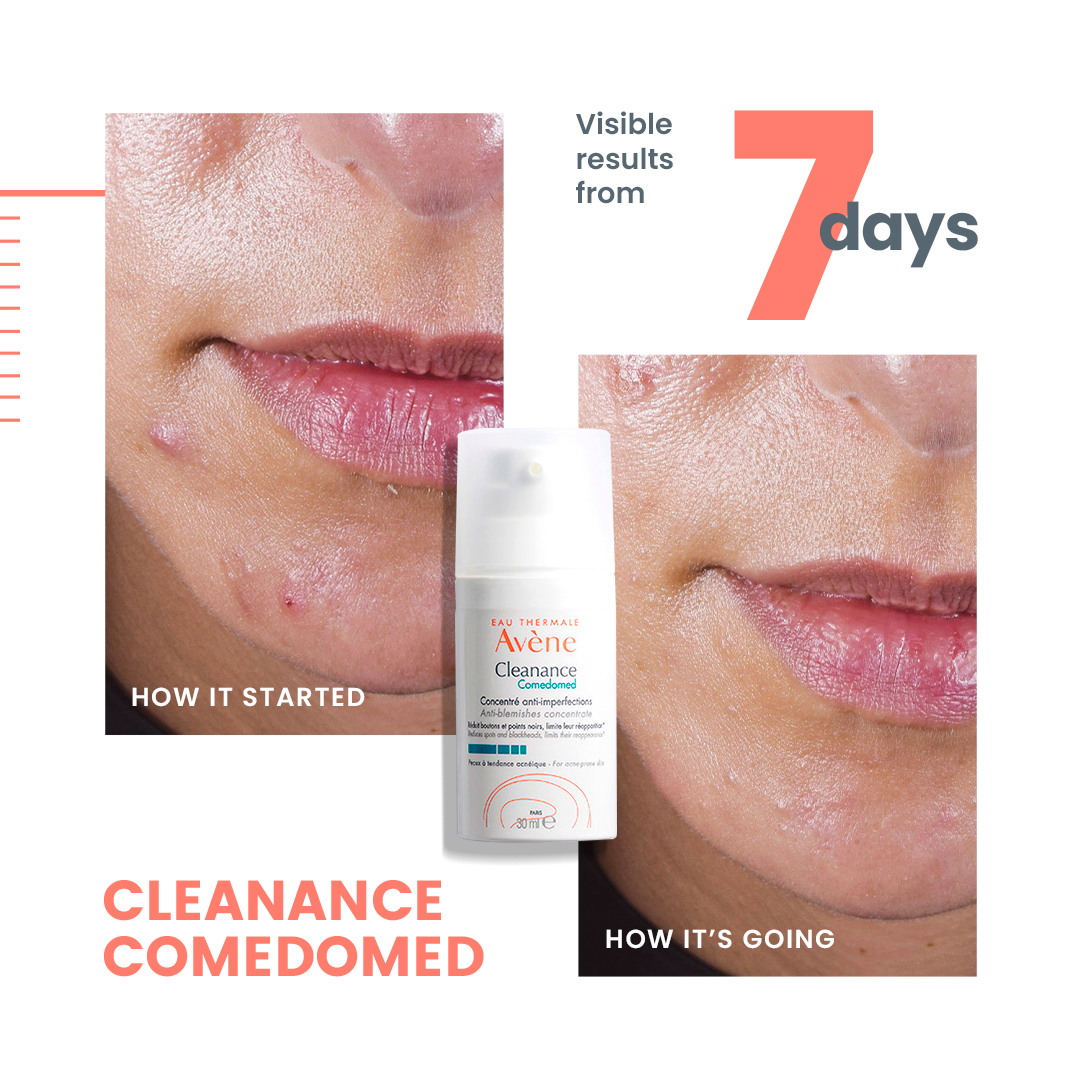Cleanance Comedomed Anti-Blemish Concentrate