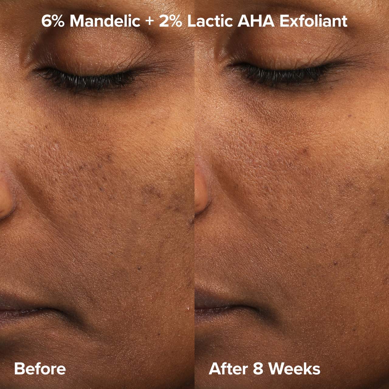 Paula's Choice - The Exfoliation Experience Kit with 2% BHA + 6% Mandelic Acid AHA - Medaid International