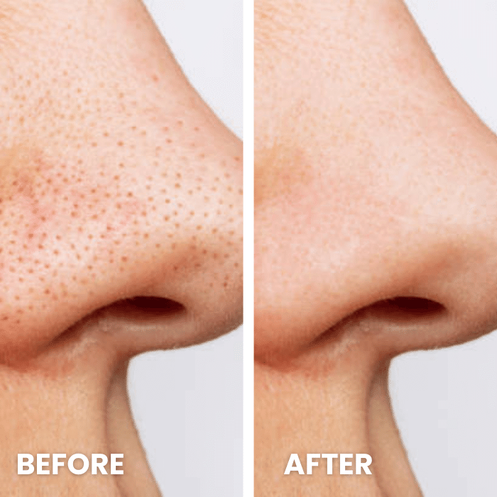 Ultrasonic Face Scrubber | Pore Purifier - Medaid International